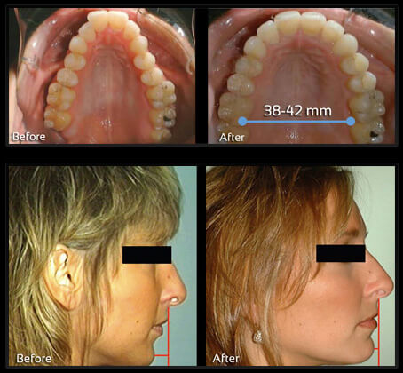 Before and after palate and profile results