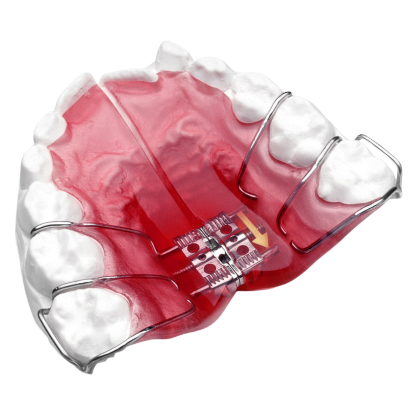 Lateral Growth Plate