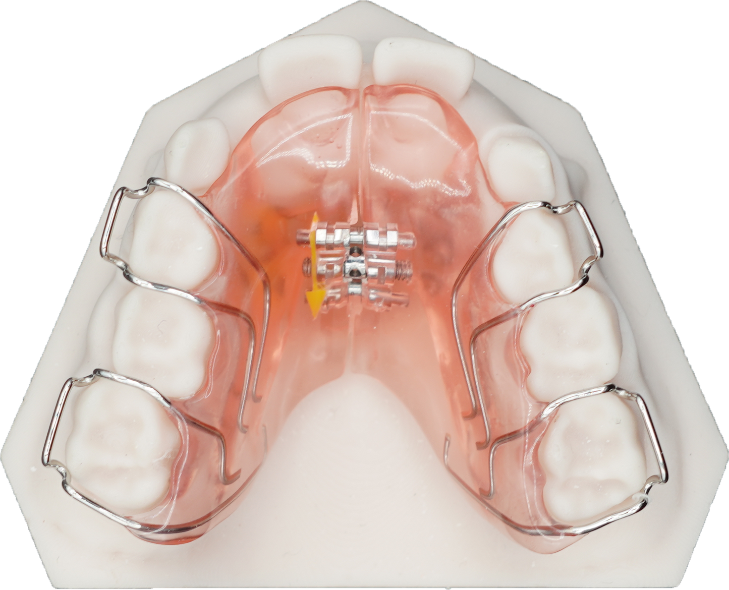Lateral Growth Plate