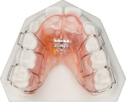 Lateral Growth Plate