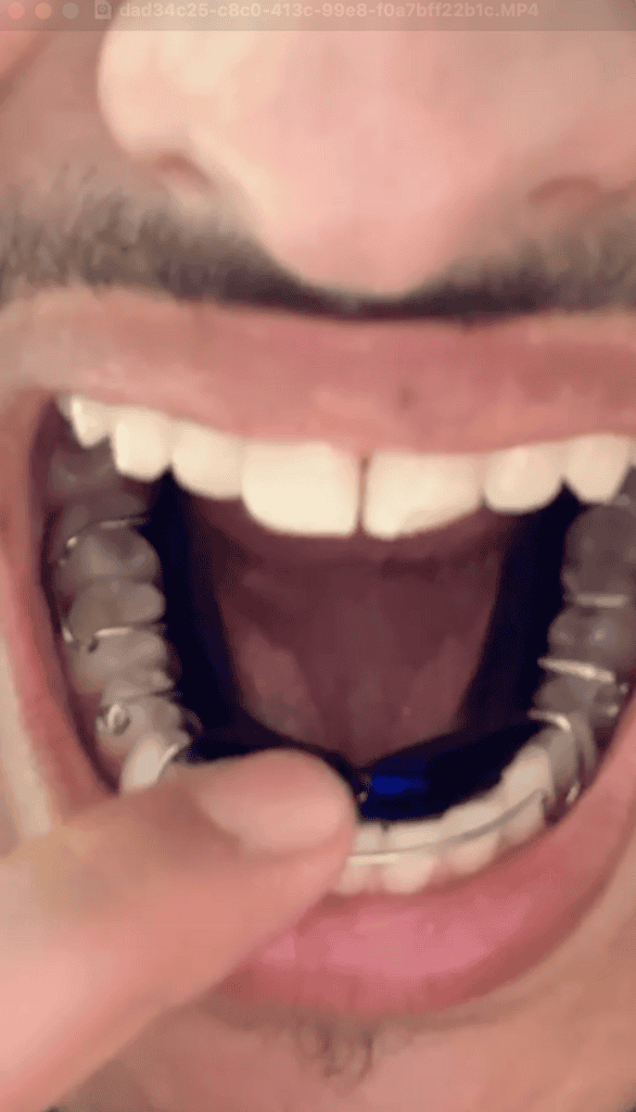 Dental appliance being adjusted in mouth