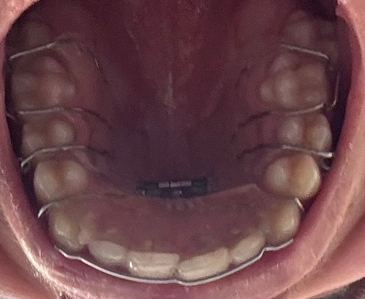 Dental appliance being worn in mouth